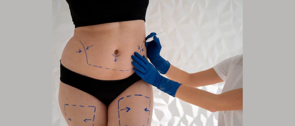 Is-It-Fine-to-Go-for-a-Liposuction