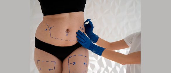 Is-It-Fine-to-Go-for-a-Liposuction