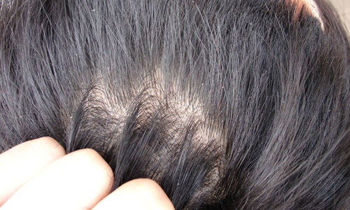 Hair-Spa-for-Dandruff