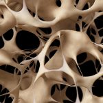 Osteoporosis Uncovered