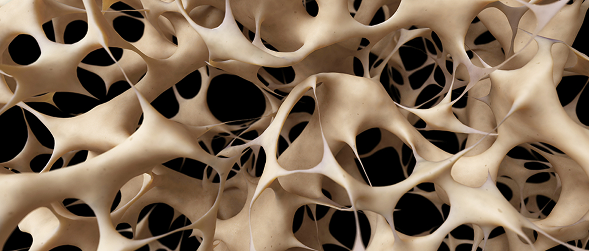 Osteoporosis : Causes, Symptoms, Prevention, Treatment