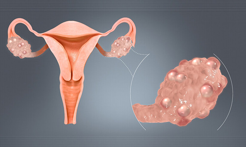 What-is-PCOS