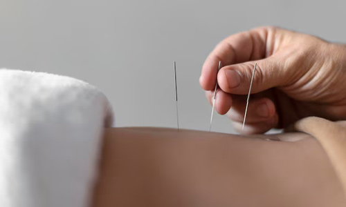 Acupuncture